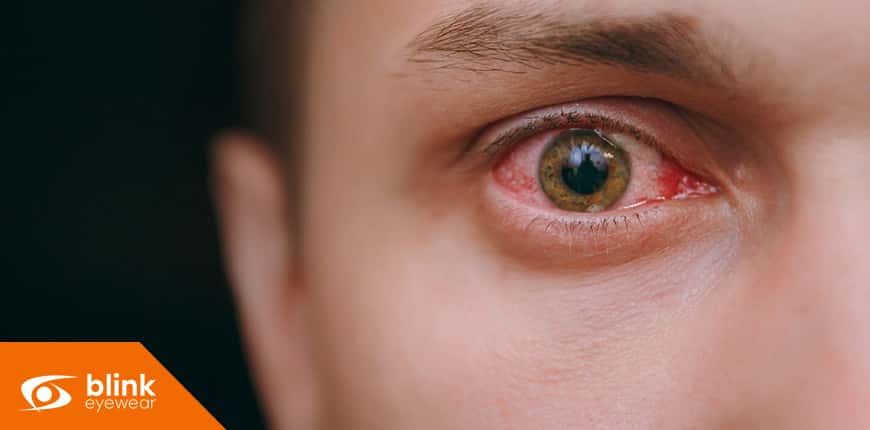 When To See An Optometrist For Pink Eye