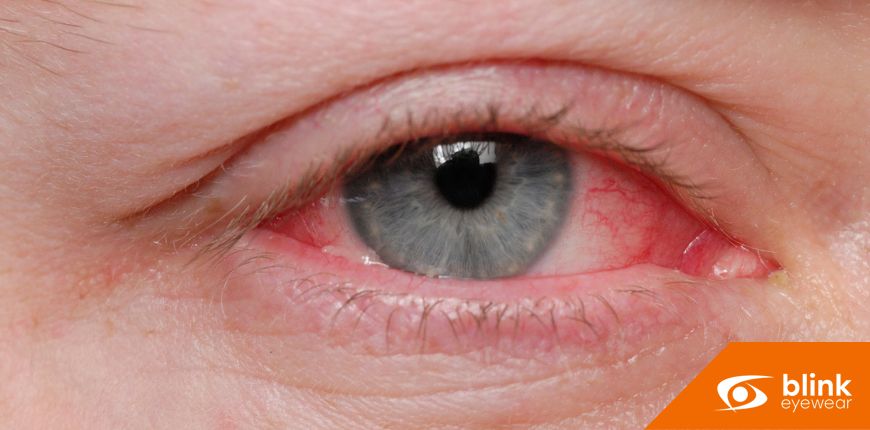 The Role of Good Hygiene in Preventing Pink Eye Outbreaks