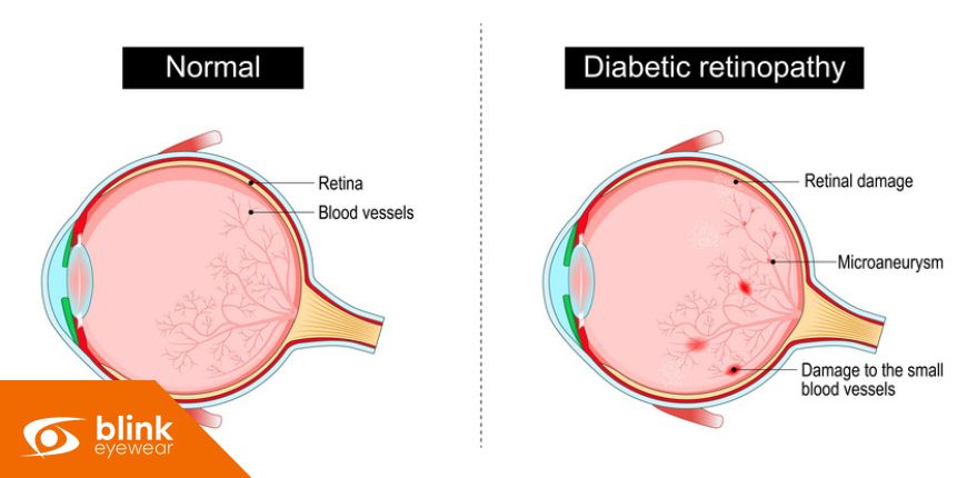 Preventing Diabetic Eye Disease: Lifestyle Changes and Management Tips