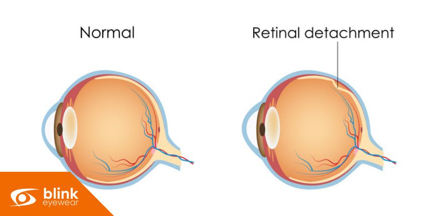 Understanding Retinal Detachment: How Early Detection and Vision Therapy Can Save Your Sight