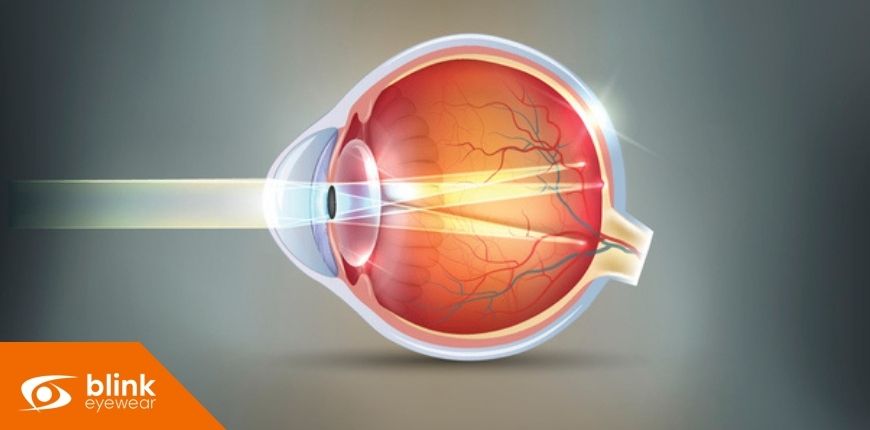 Is Astigmatism Affecting Your Vision? How to Get the Right Diagnosis & Treatment