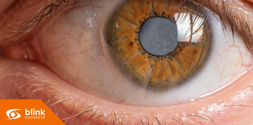 Top Cataract Treatment Options in Calgary: Restoring Clear Vision 