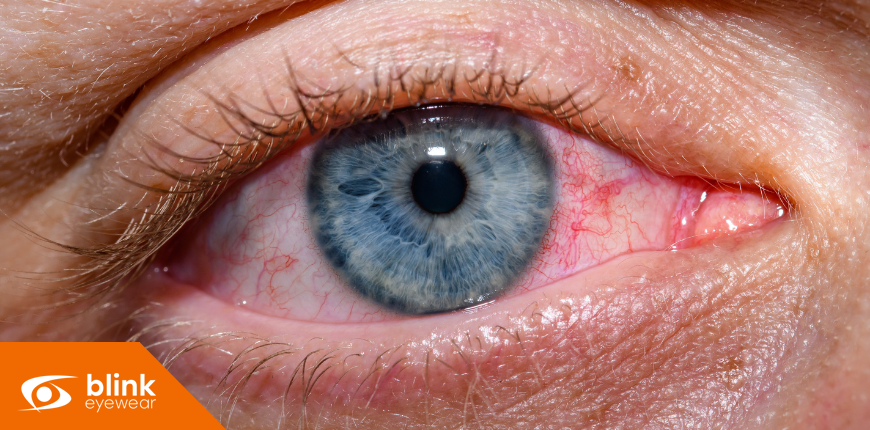 From Drops to Devices: Modern Dry Eye Treatment Options in Calgary